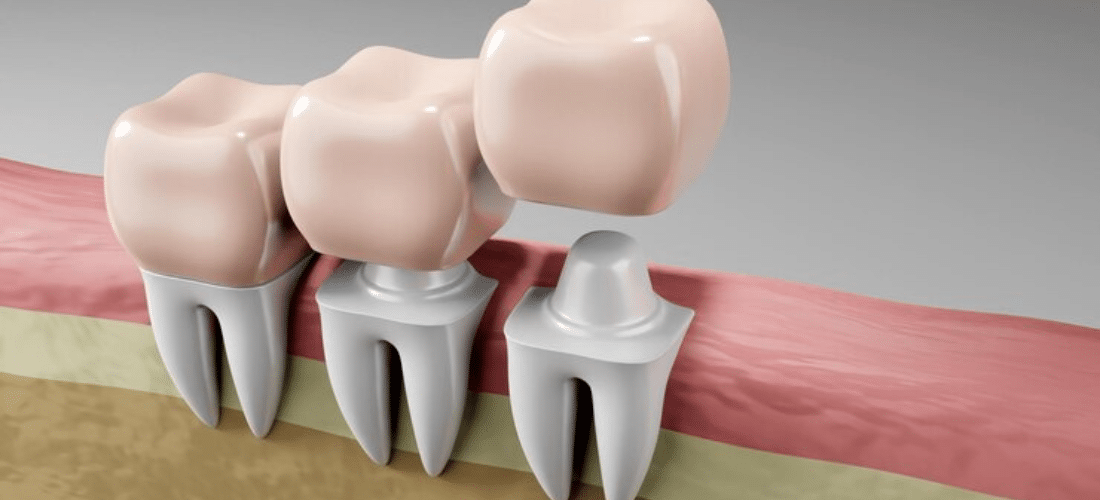 Dental Implants in Richmond VA - Best Smiles