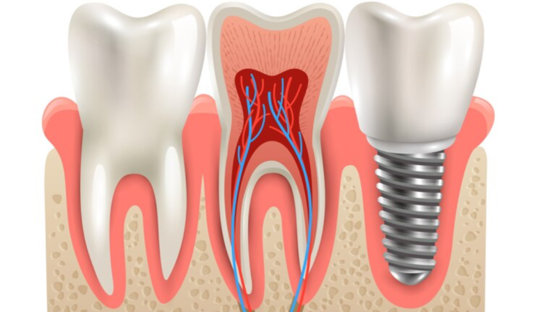 10 Common Signs You Need a Root Canal