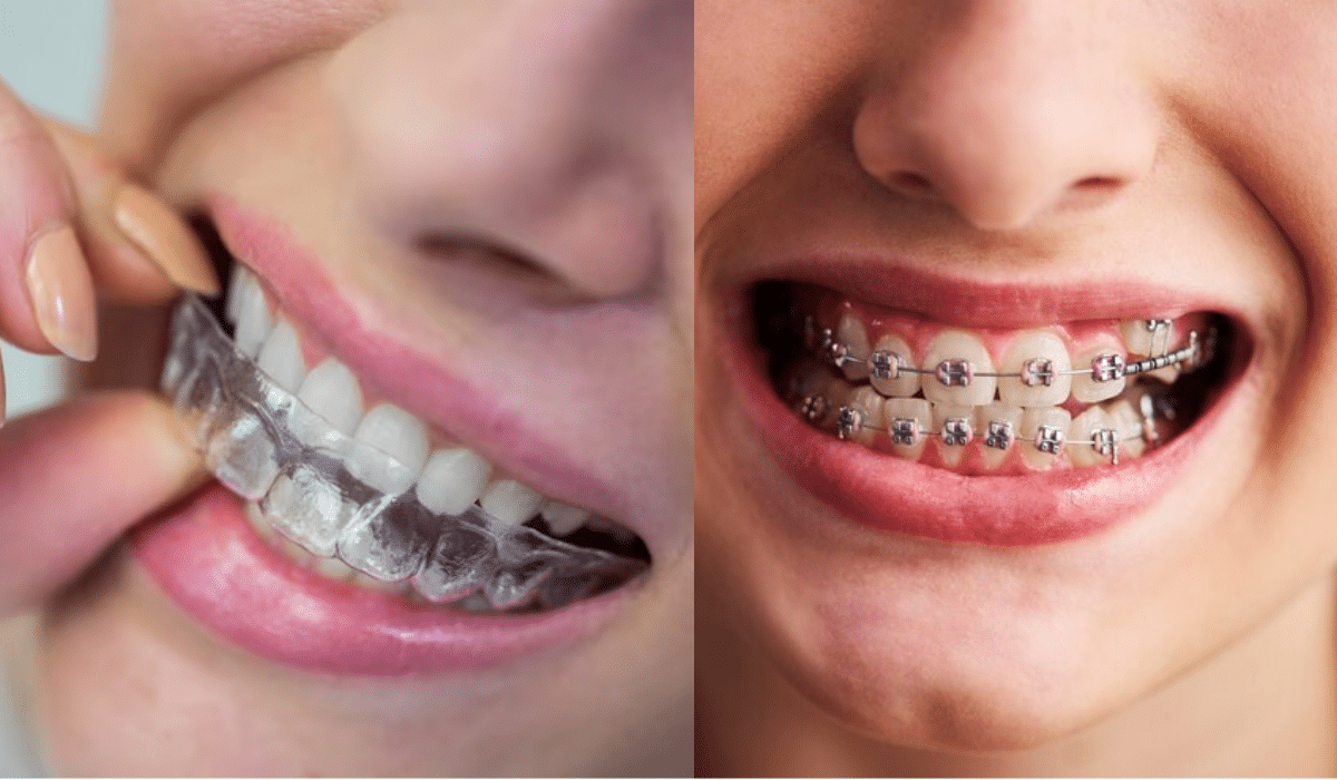 Transparent, invisible, removable braces / aligners for tooth corrections