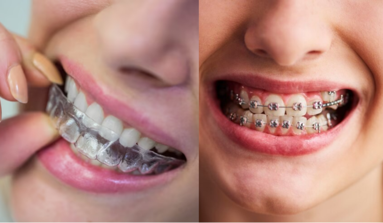 Clear Aligner Braces vs Traditional Braces – What’s Better For You?