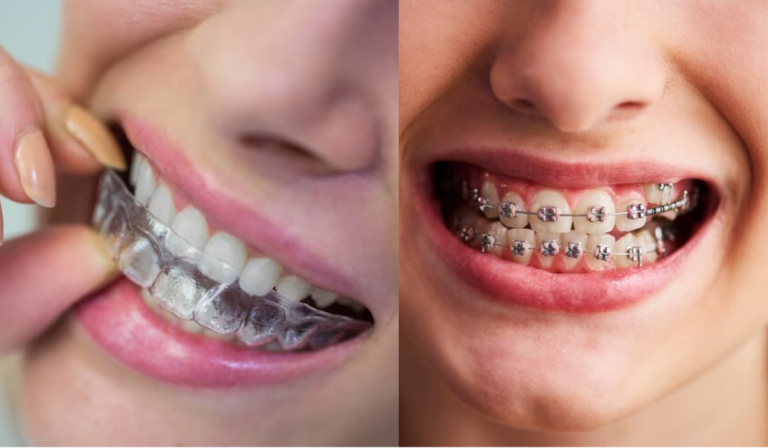 Clear Aligner Braces vs Traditional Braces – What's Better For You