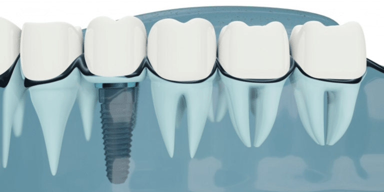 Understanding The Value of Dental Implants