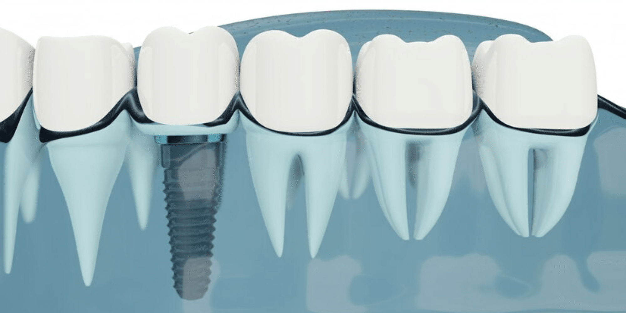 value of dental implants