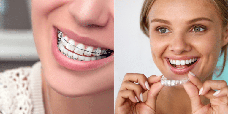 Braces vs. Invisalign: Choosing the Perfect Option for Adult Teeth Alignment