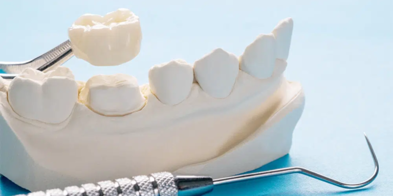 How Long Do Porcelain Crowns Last? Maintaining Your Dental Restoration