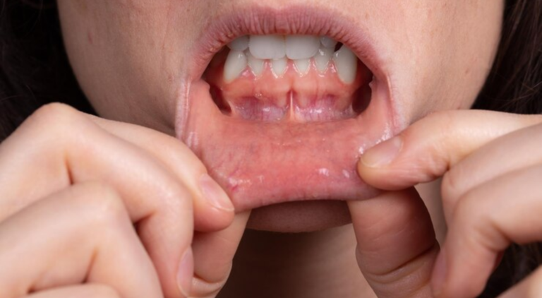 What Causes Canker Sores? Understanding the Triggers and Treatments