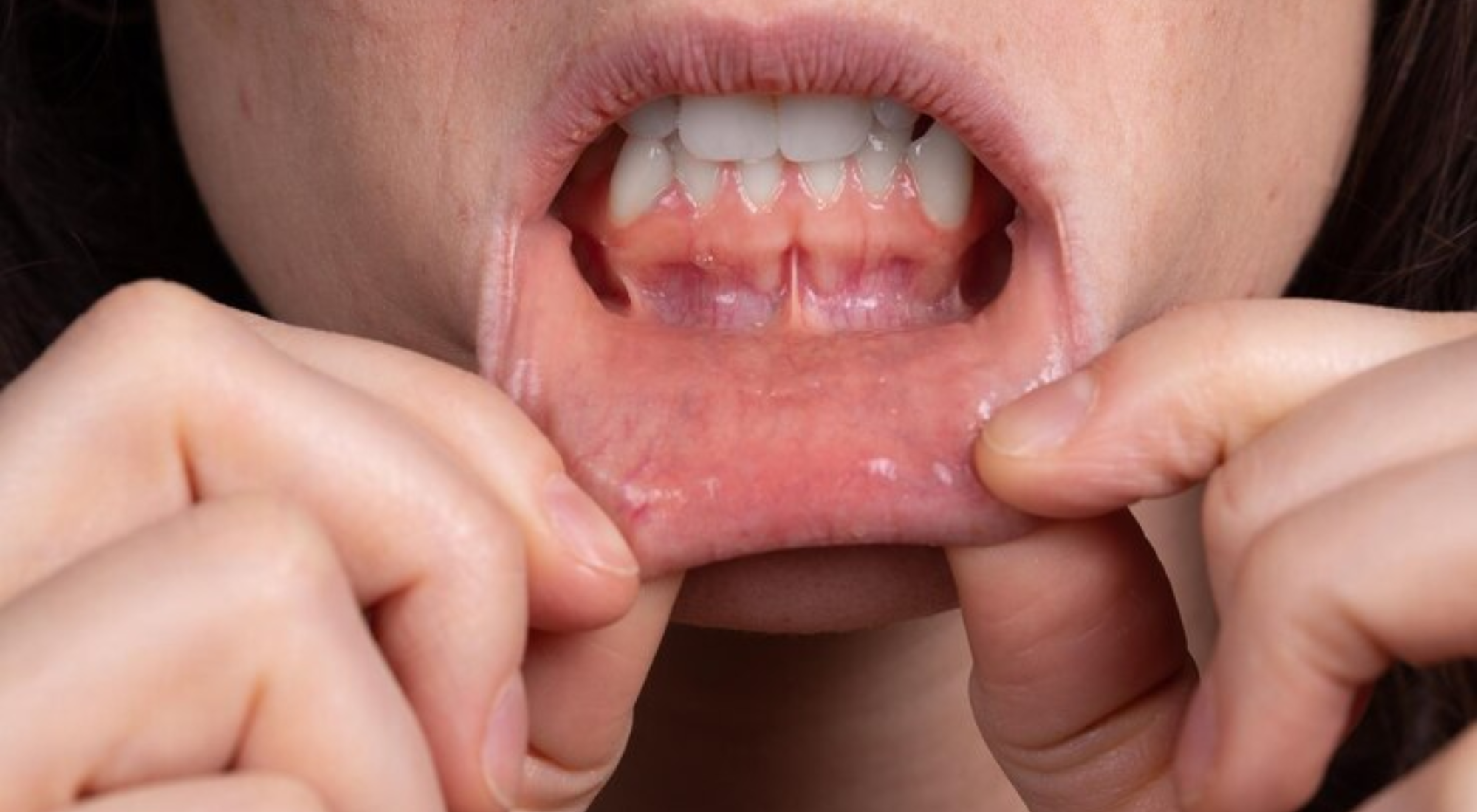 oral canker sores