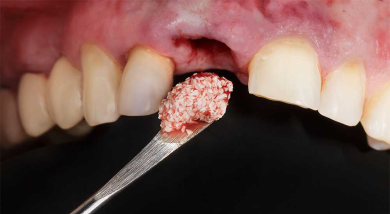 Recovery After Bone Grafting: Minimizing Discomfort