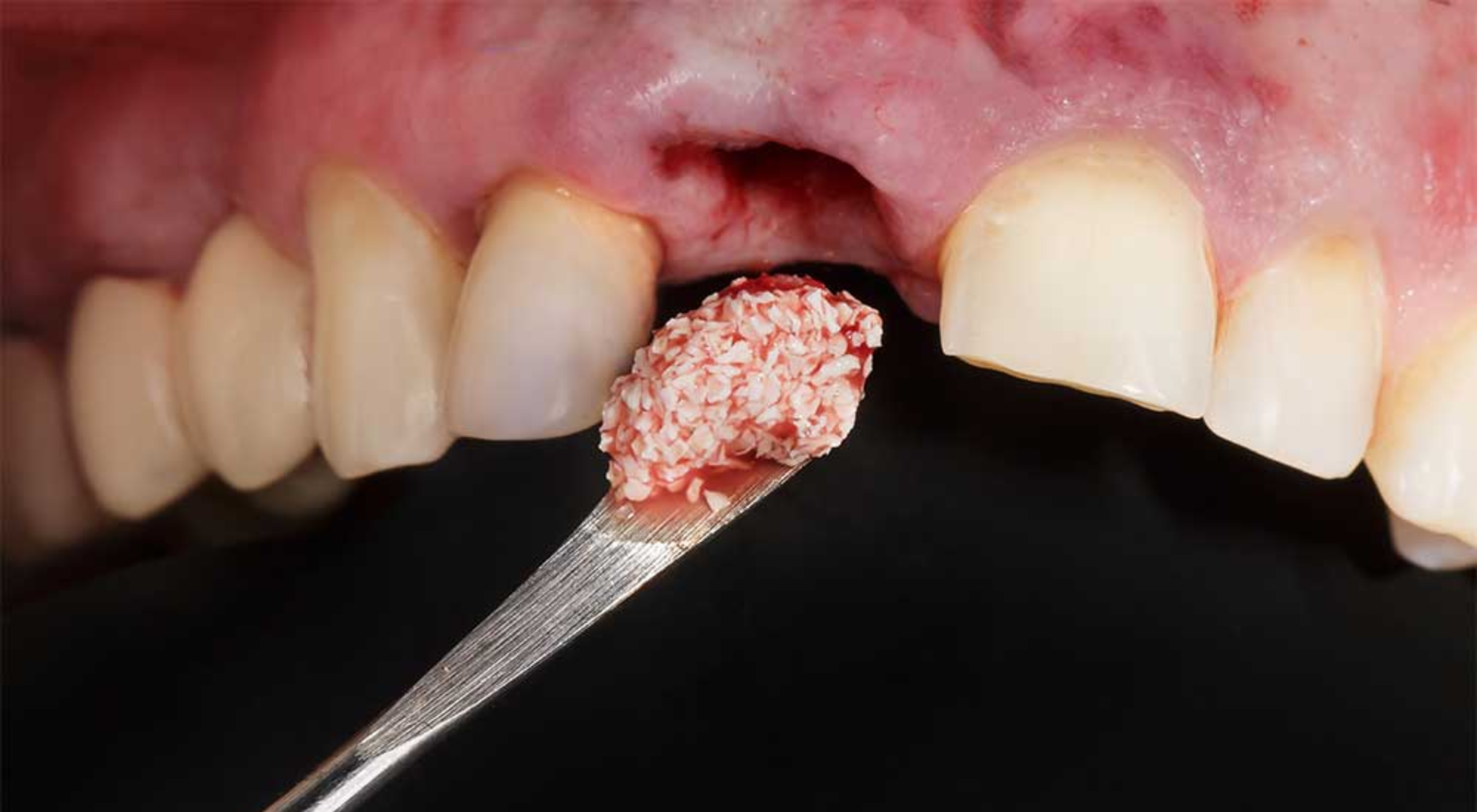 recovery after bone grafting