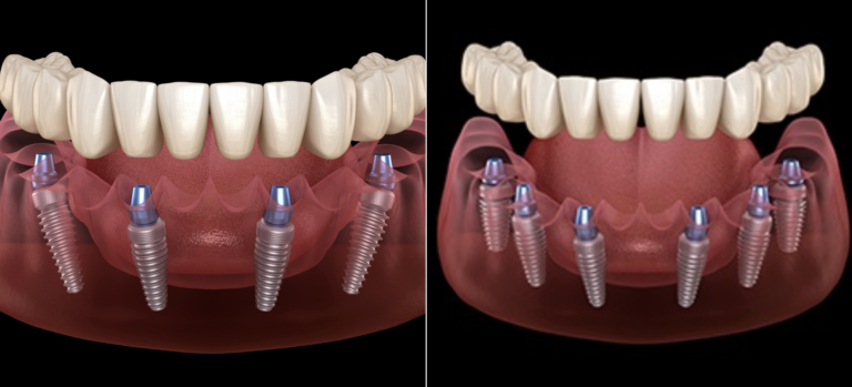 All You Need To Know About All In 4 And All In 6 Implant