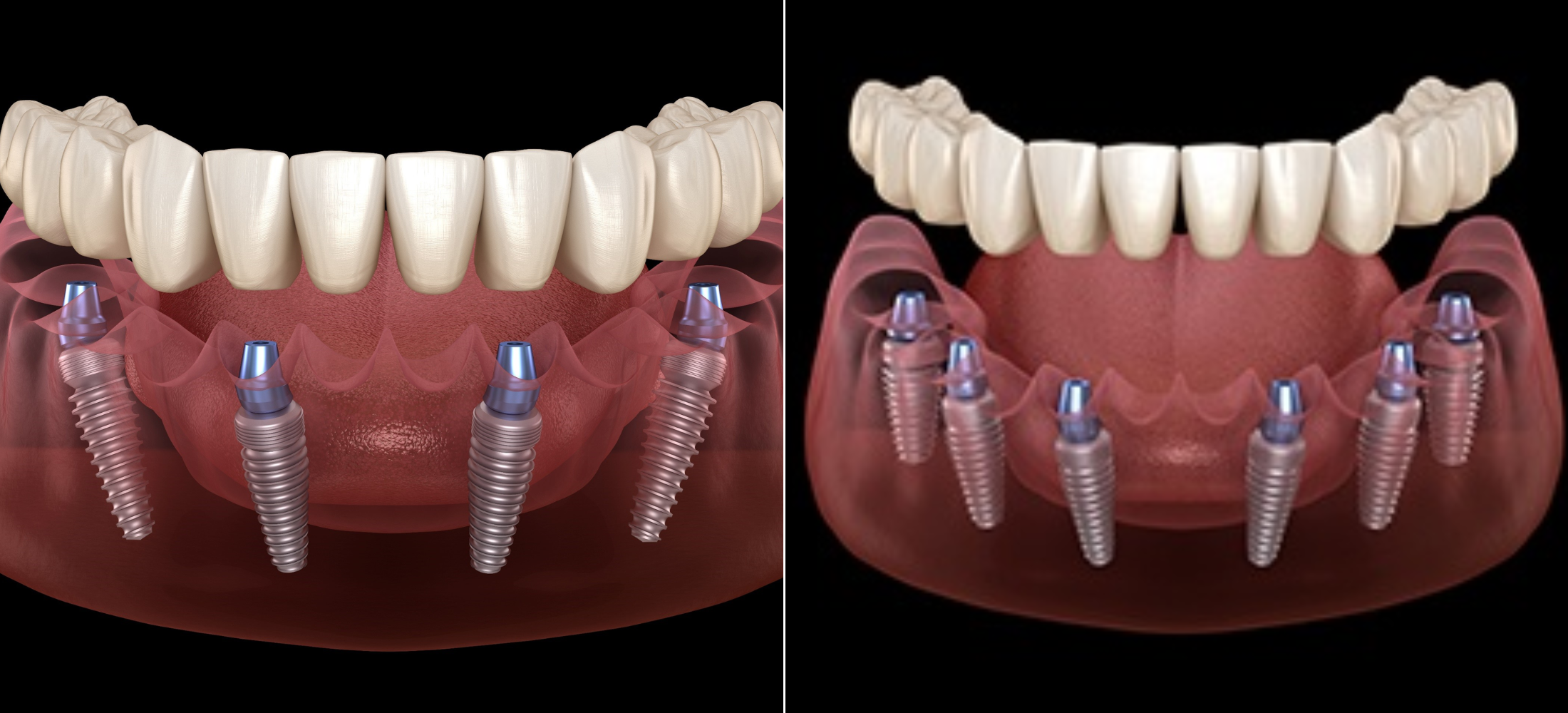 all in 4 and all in 6 implant