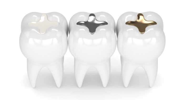 common mistakes to avoid after a dental composite filling