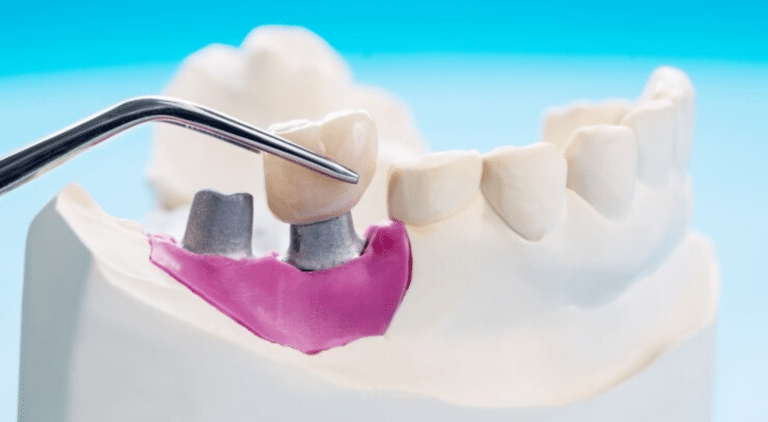 essential dental crown aftercare tips for a healthy smile