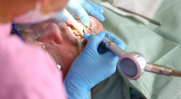 tooth extraction with root in sinus cavity