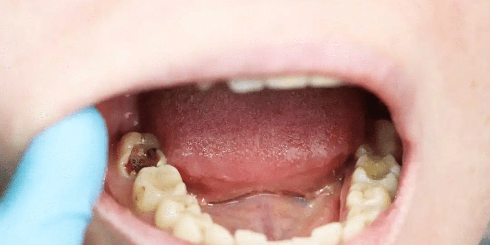 how do you know when a cavity is really bad