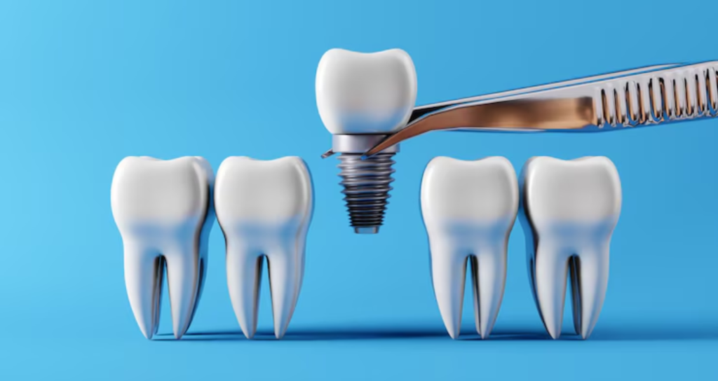 how many days should you rest after dental implant