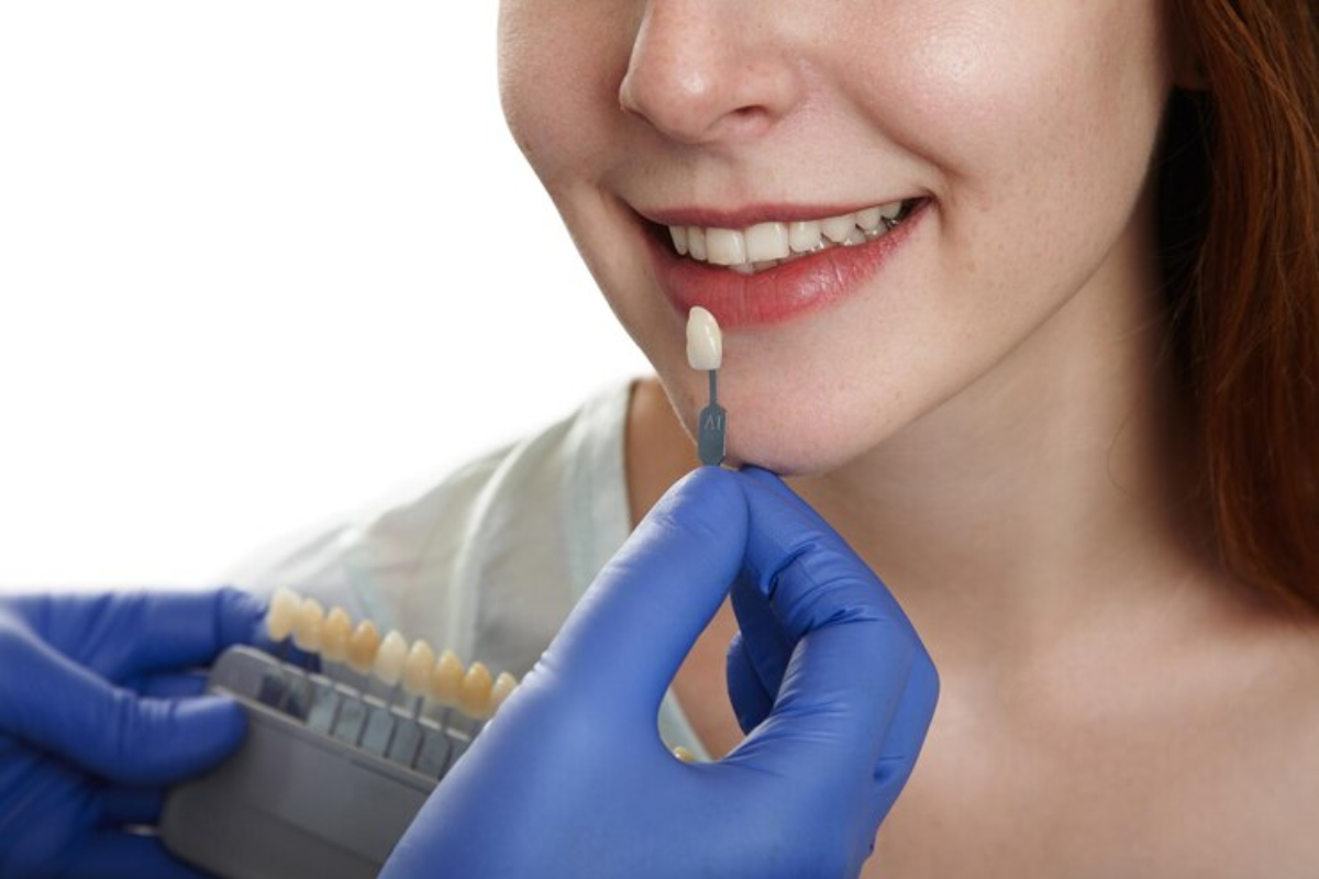 Can Whitening Strips Damage Porcelain Veneers? Expert Advice