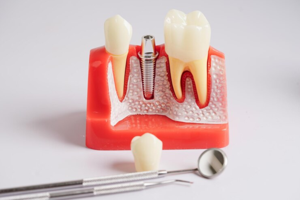 should you rest after dental implant