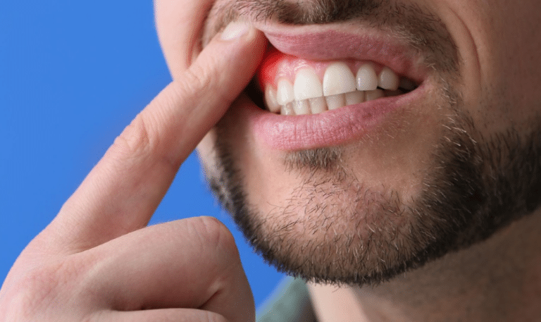 Stages of Gum Disease