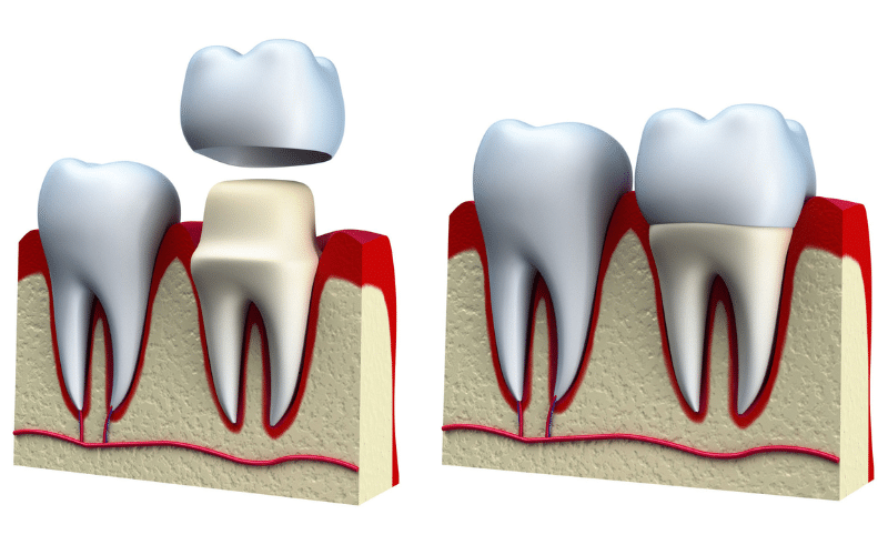 Take Care Of Your New Dental Crown