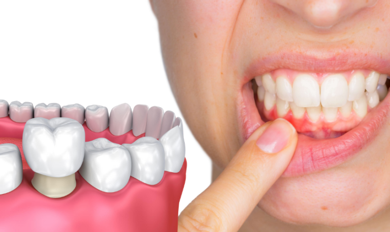 Dental Crowns and Gums