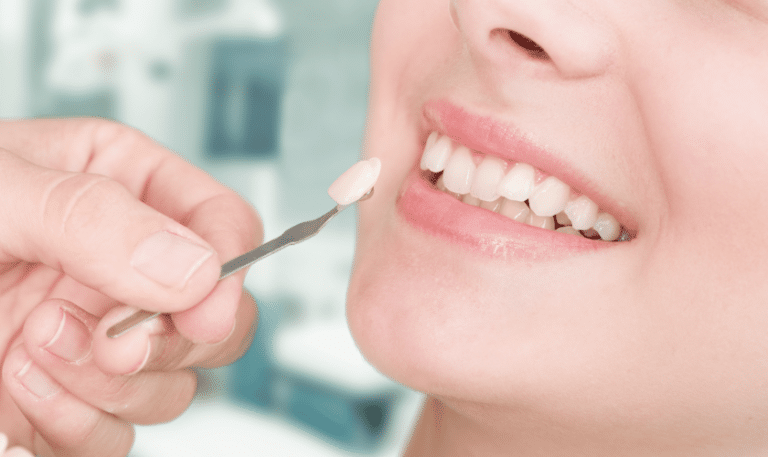 Caring for Porcelain Veneers