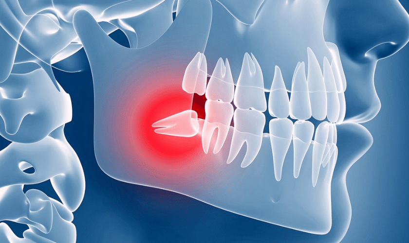 Wisdom Teeth Removal