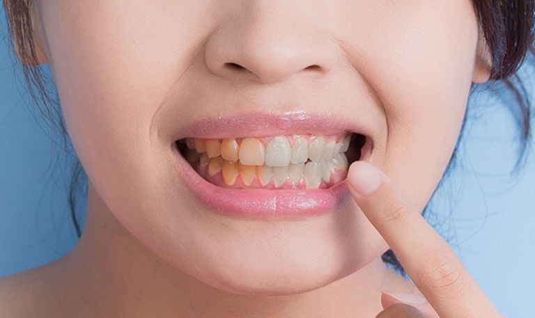 Why Teeth Stay Yellow After Whitening