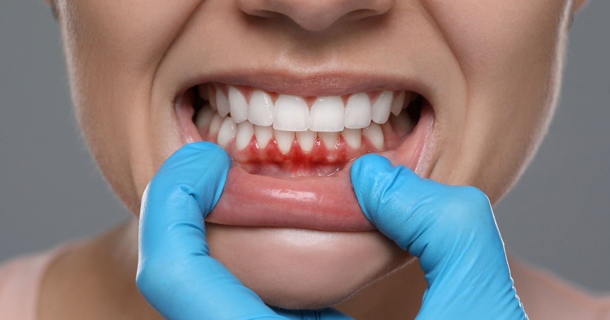 causes bruised gums and how to treat them