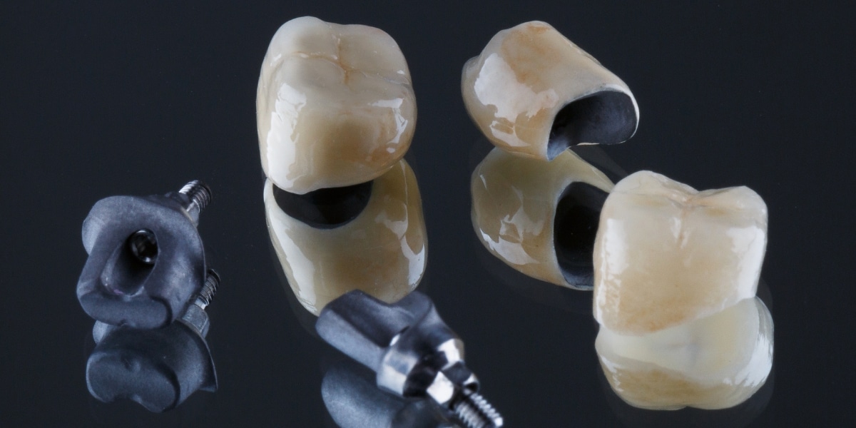 lab crowns vs same-day crowns