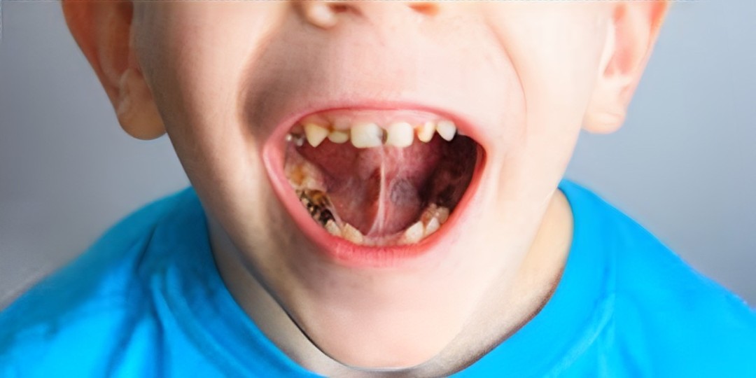 ways to prevent and remove black stains on baby teeth