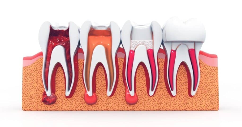 what is the typical rest time required after getting a root canal