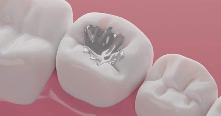 5 reasons why tooth-colored fillings are the superior choice