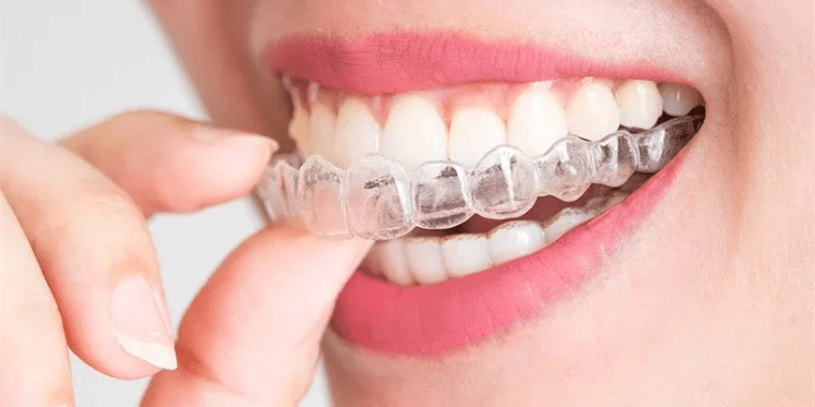 How to Keep Your Clear Aligners Clean and Odor-Free