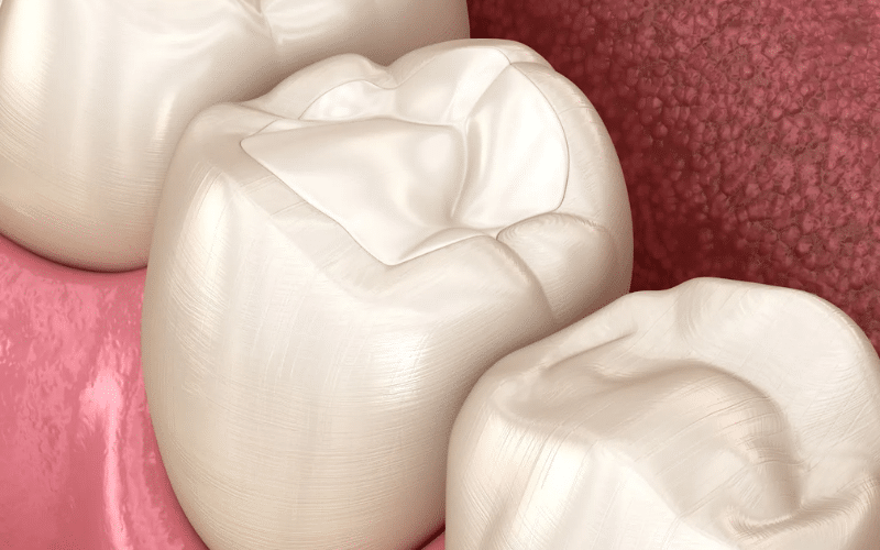 Why Tooth-Colored Fillings Are Superior Choice