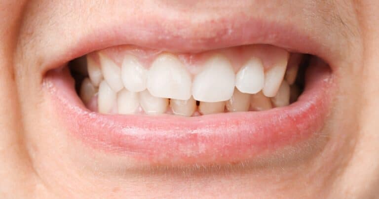 how can a misaligned bite cause wear on your teeth