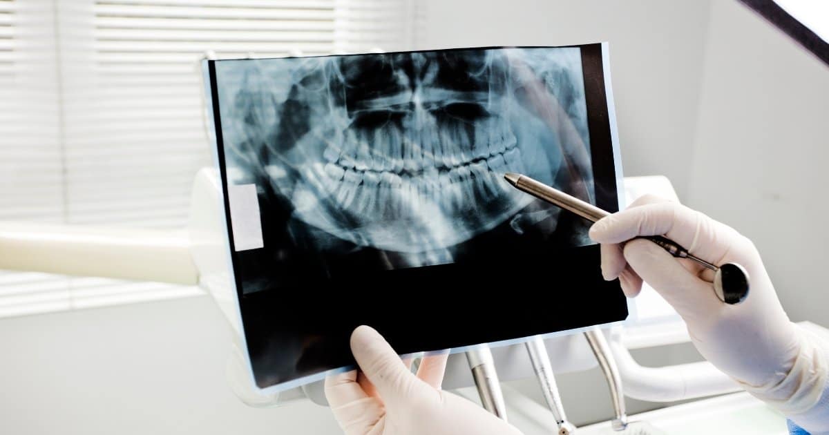 how safe are dental x-rays and how do they work