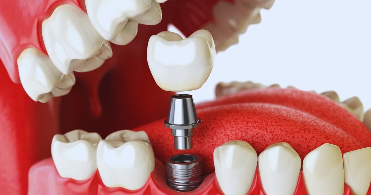 what happens if you wait too long for dental implants after tooth loss