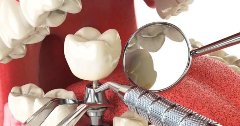 considerations before getting dental implants