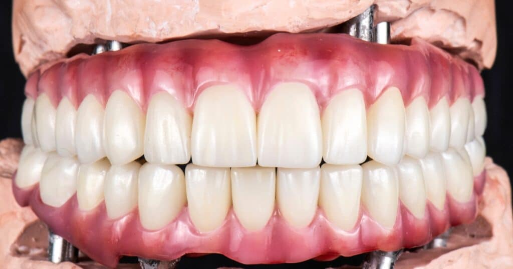 dental implants for oral health