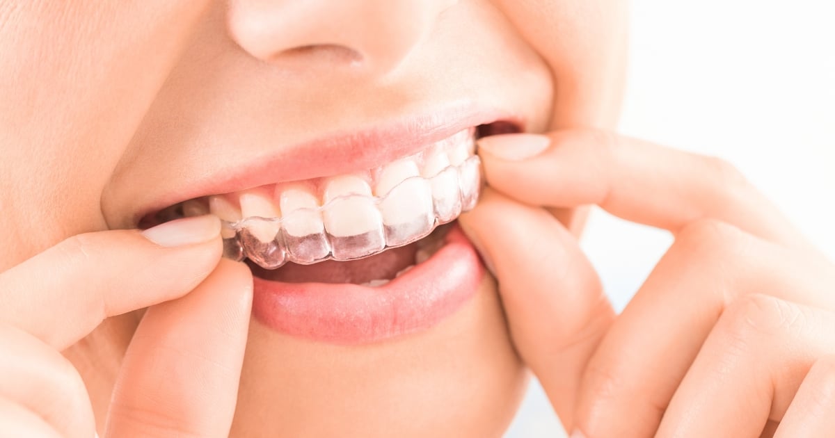 invisalign for crowded teeth