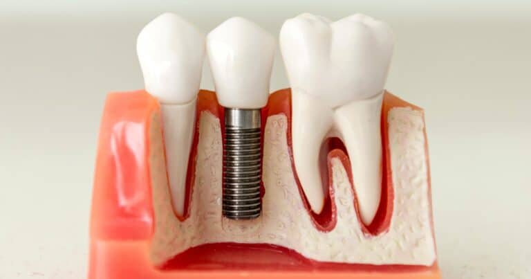 dental implants after previous dental work