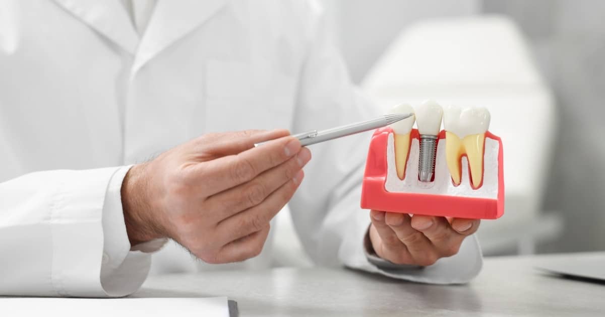 common myths about dental implants