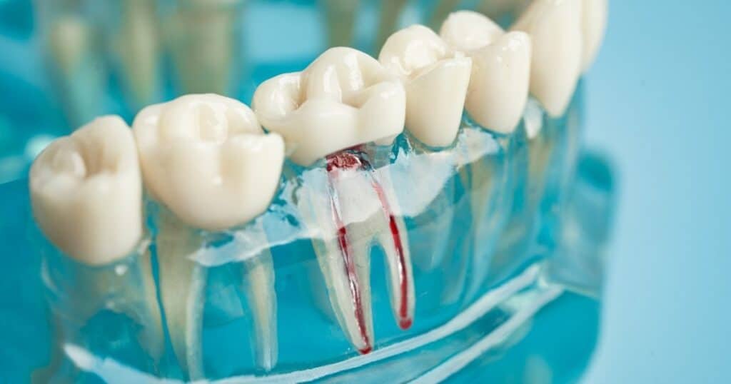 diabetes and root canals