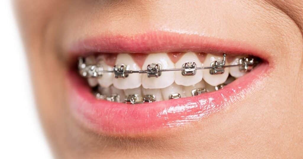 emergency care for broken braces and wires