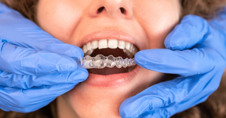 invisalign to close teeth gaps