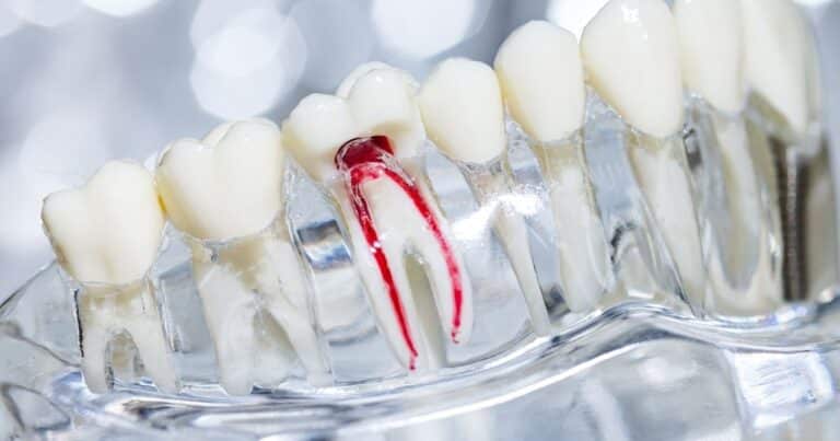 root canals for seniors