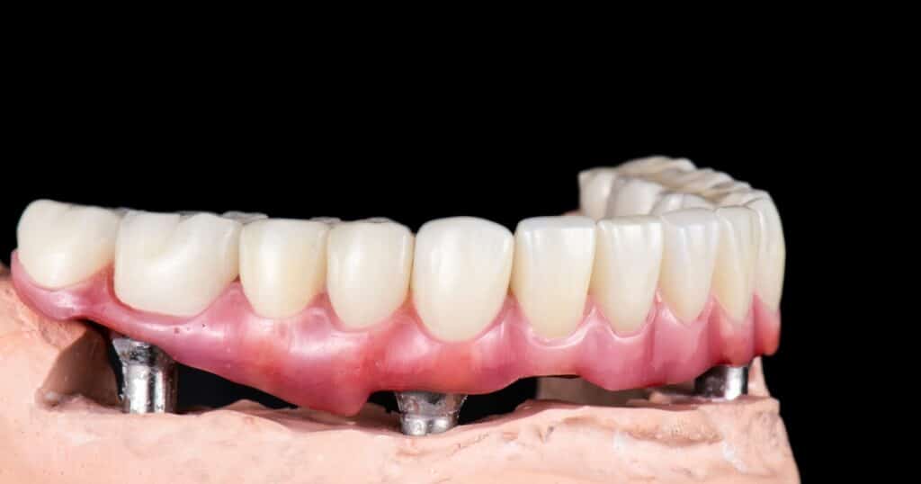 the benefits of implant supported dentures