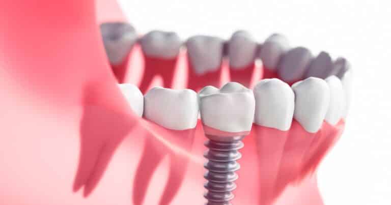 dental implants for bite and chewing function