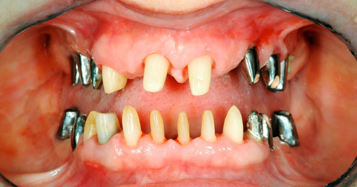 Full Mouth Reconstruction Recovery: What to Expect
